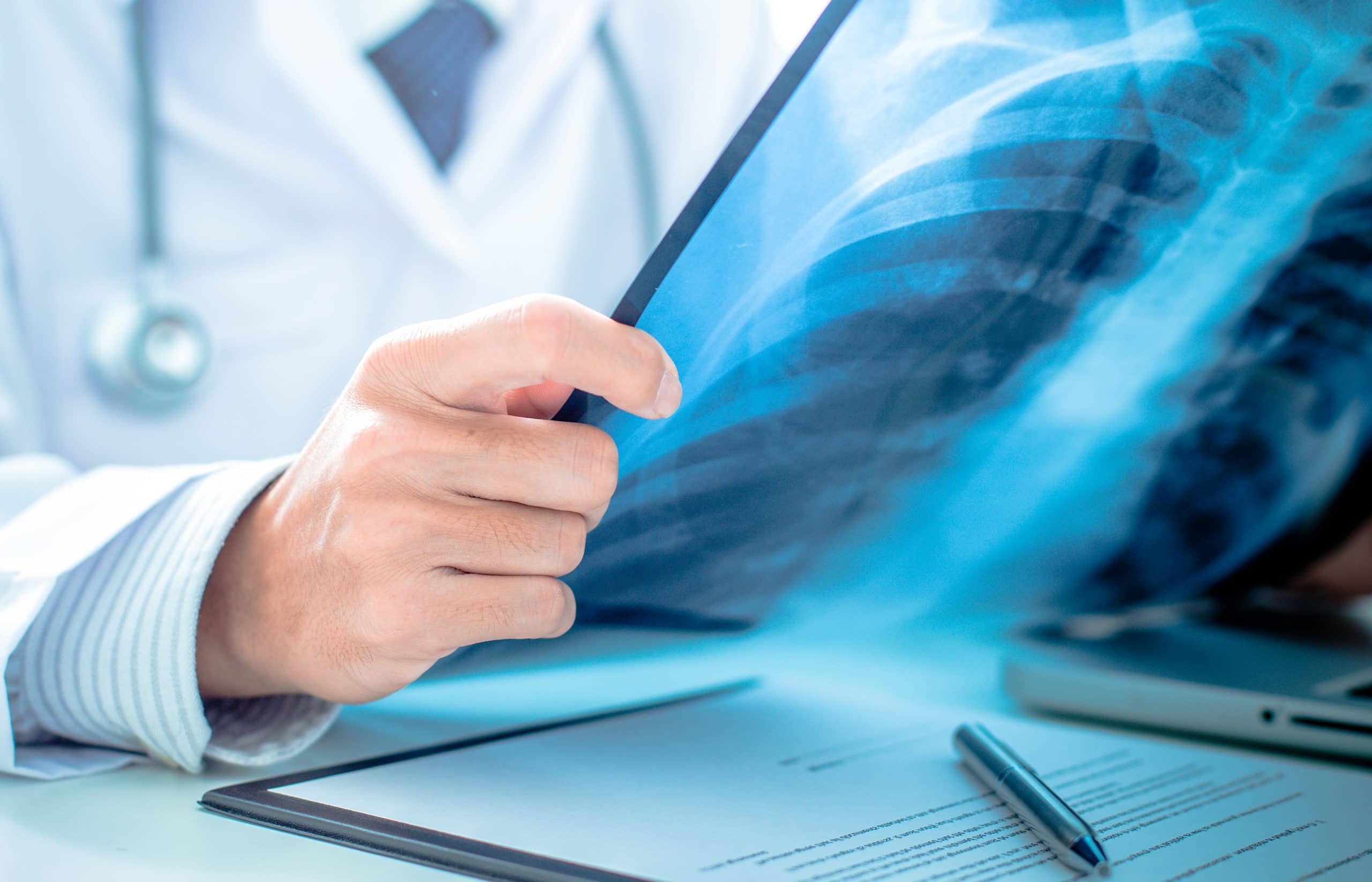 This is an image of a doctor looking at an x-ray of lungs with lung cancer.
