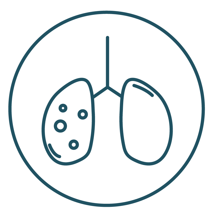 This is an icon representing stage II of lung cancer.