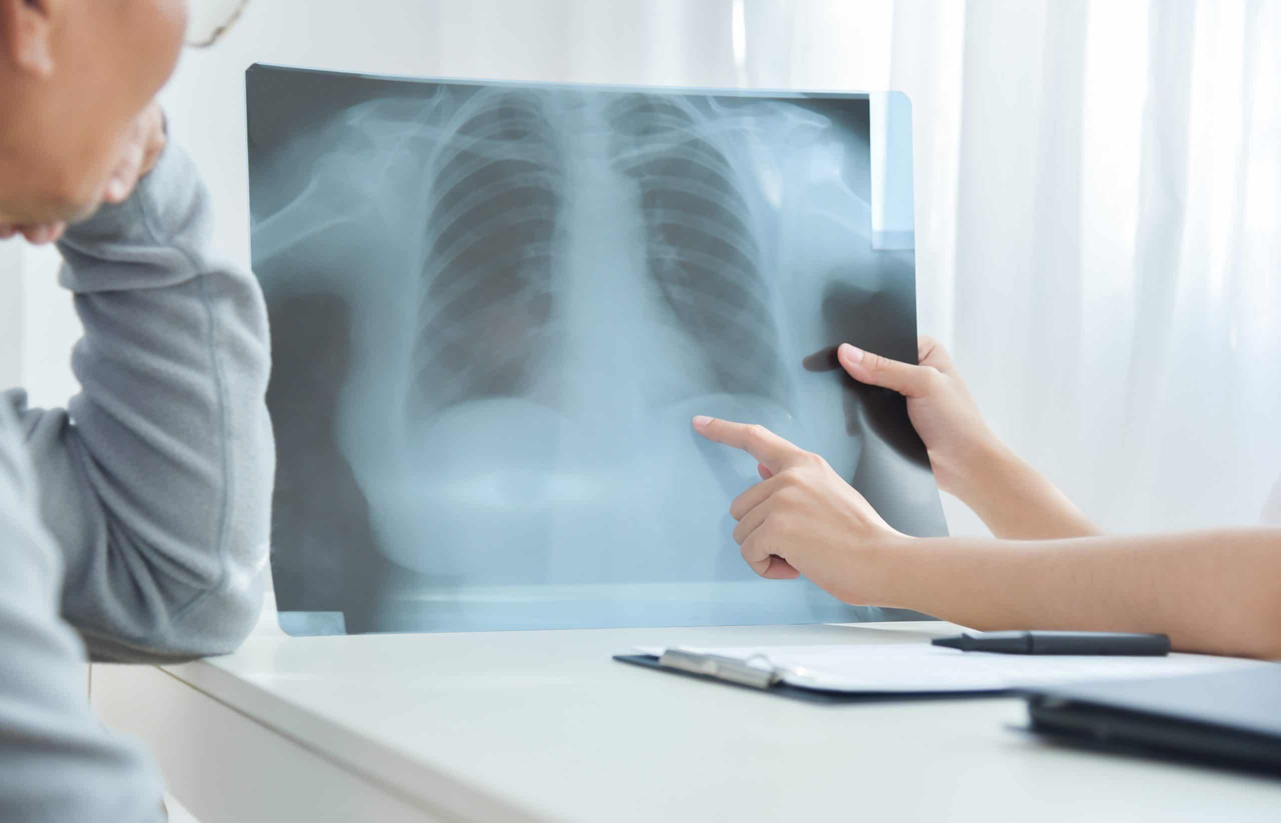 This is an image representing a doctor showing a patient possible asbestosis in their lungs.