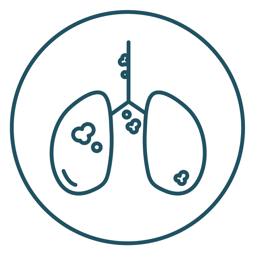 This is an icon representing Stage III - Extended in Lung Cancer Staging.