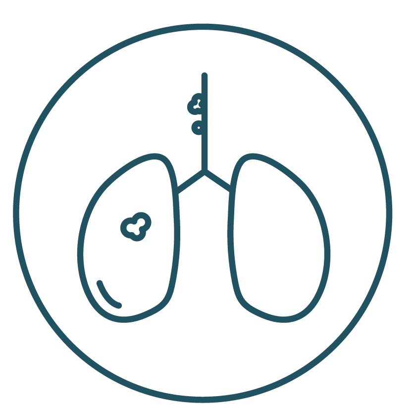 This is an icon representing Stage IIIA in Lung Cancer Staging.