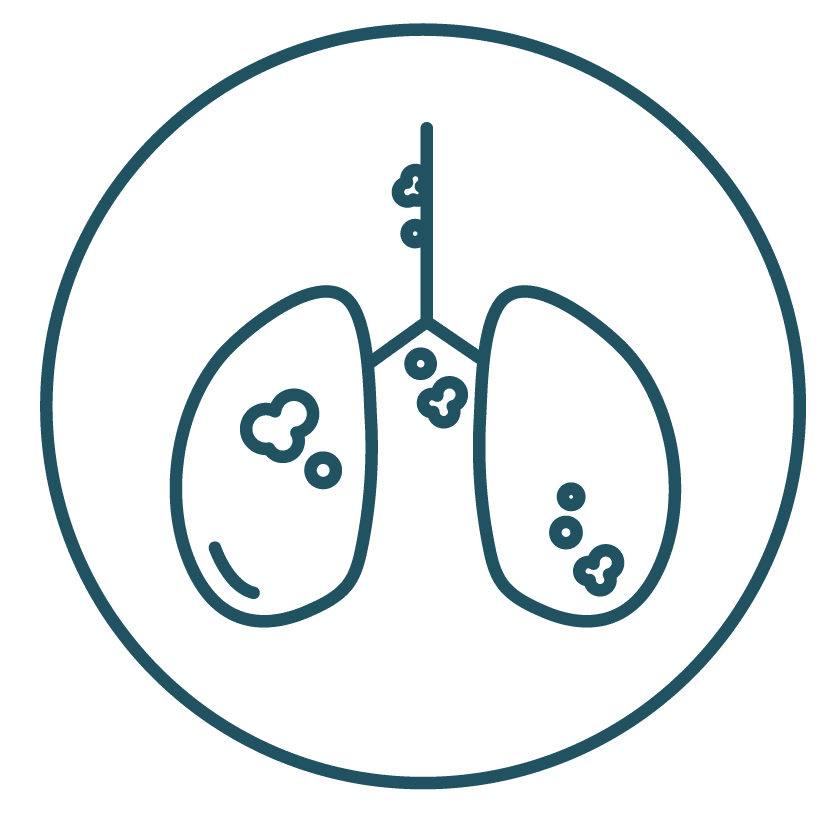 This is an image representing Stage IV - Extended in Lung Cancer Stage.