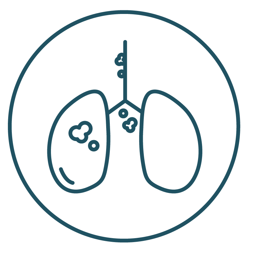 This is an icon representing Stage IIIC in Lung Cancer Staging.