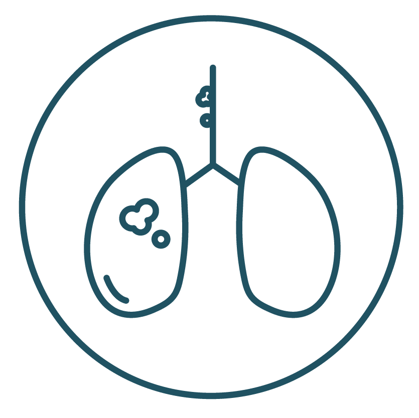 This is an icon representing Stage IIIB in Lung Cancer Staging.