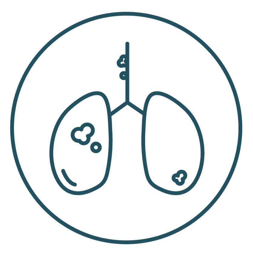 This is an image representing Stage IVA in Lung Cancer Stage.