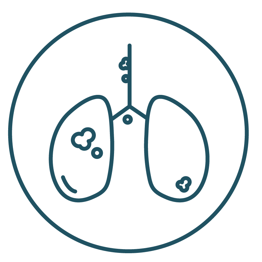 This is an image representing Stage IVB in Lung Cancer Stage.