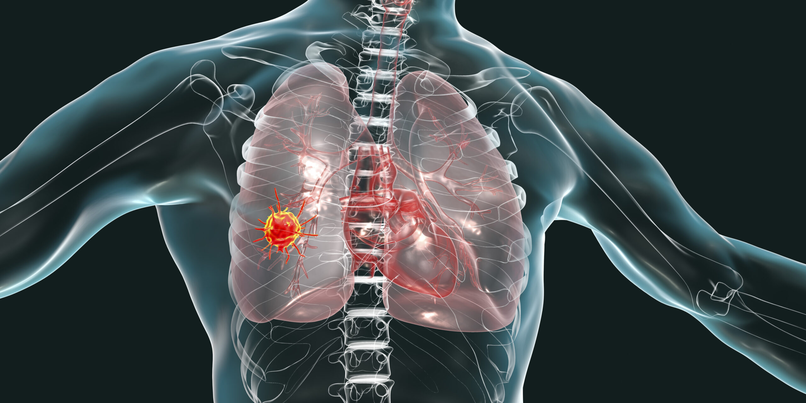 Lung cancer, conceptual image.