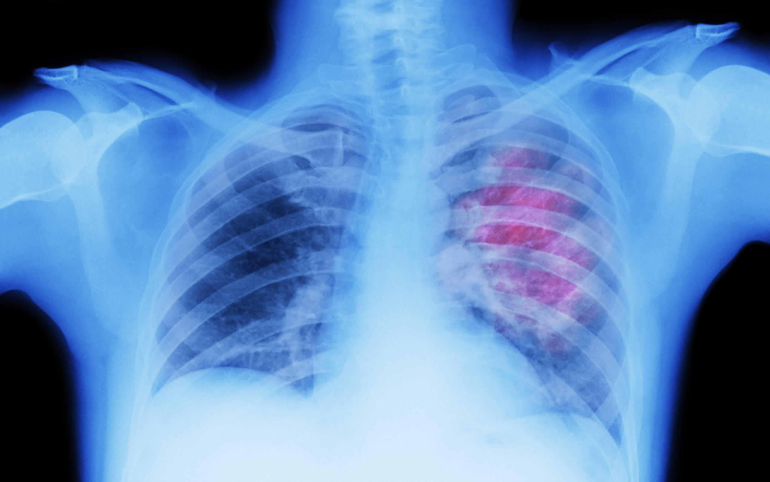 X-ray showing if a patient's stage 4 lung cancer is curable