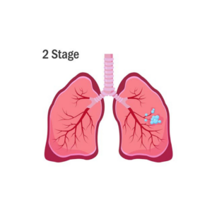 early mesothelioma in pleural lining and lung