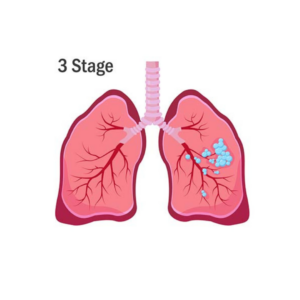 mesothelioma stage 3