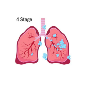 mesothelioma stage 4