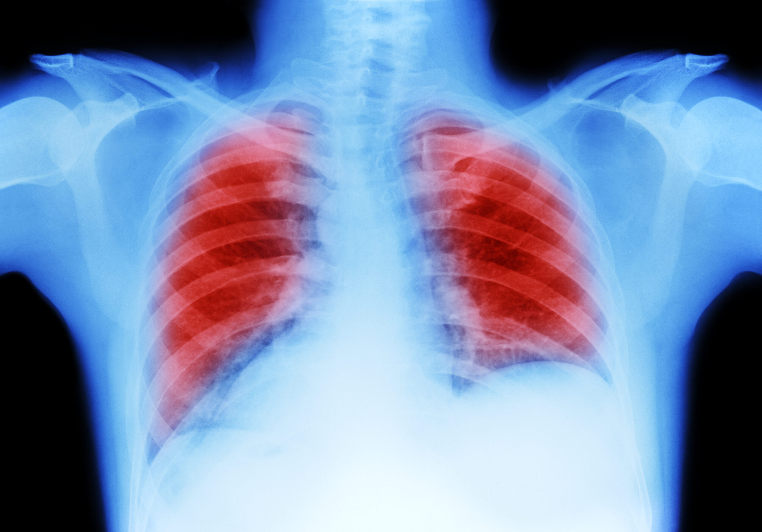 An x-ray image of chest shows active mesothelioma caused by asbestos exposure.