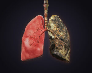 Healthy lung compared to smoker lung