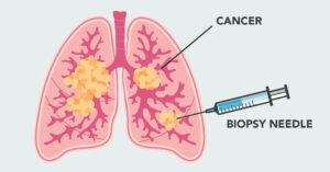 Mesothelioma biopsy graphic