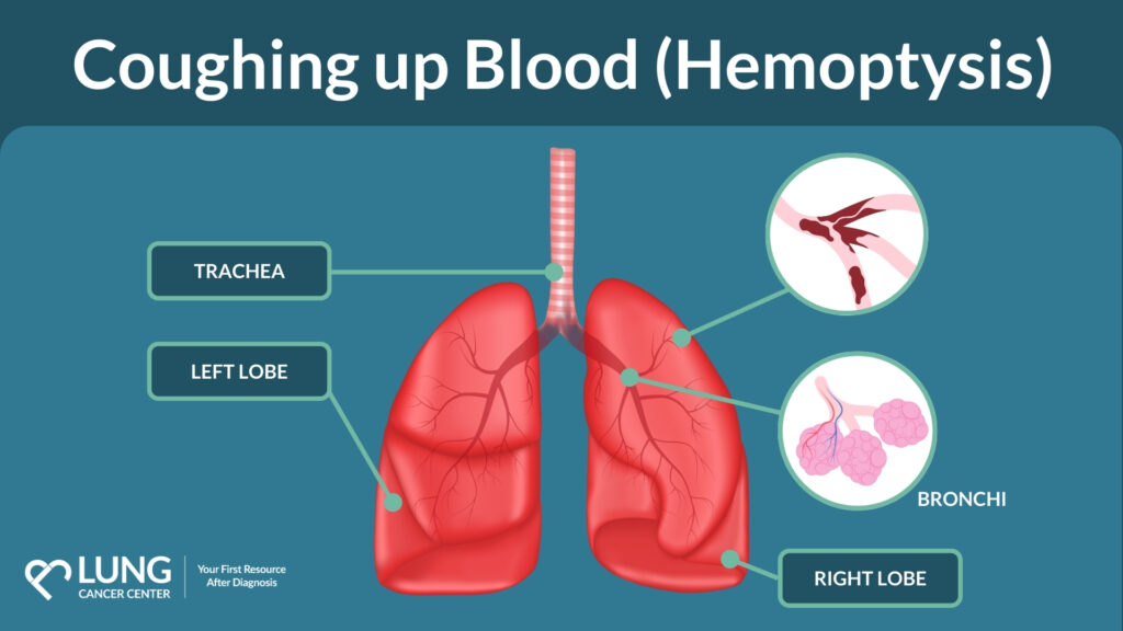 coughing-up-blood-hemoptysis-is-it-a-lung-cancer-symptom
