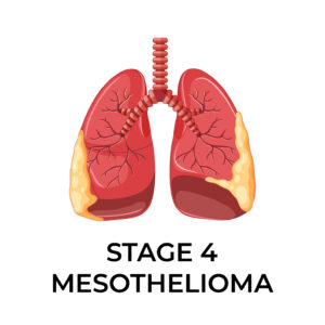 stage 4 mesothelioma