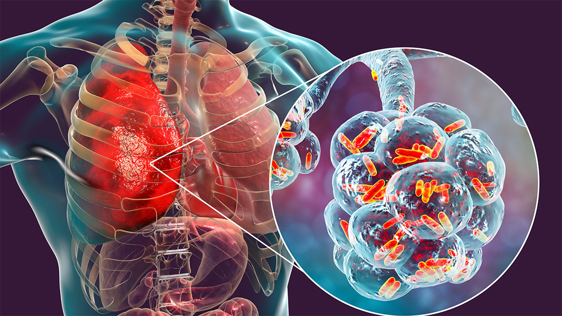 Animation of rod-shaped bacteria (bacilli) inside the alveoli of the lungs, causing a lung infection, a common symptom of lung cancer.