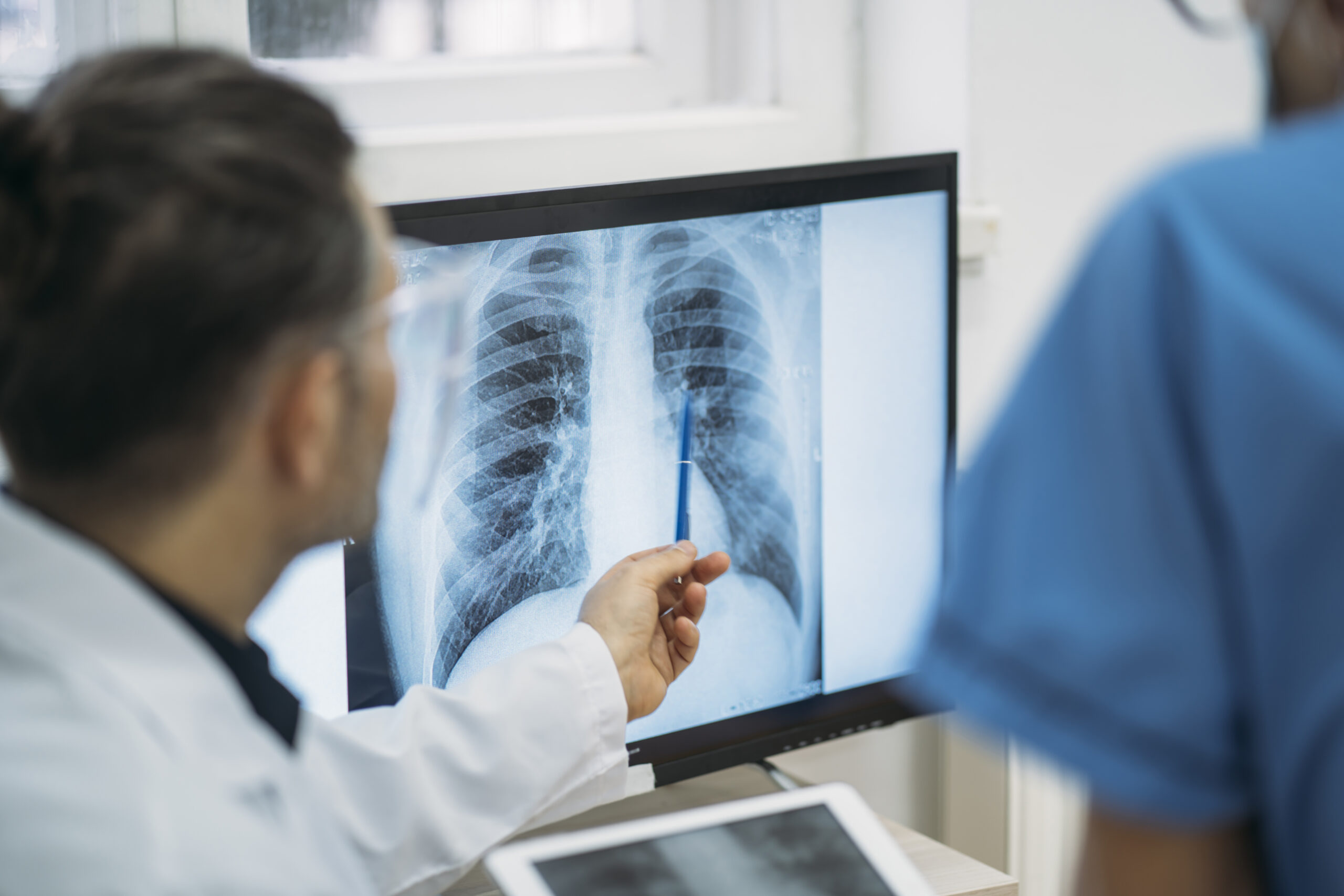 Doctor examining x-ray of lungs showing stage 2 mesothelioma.