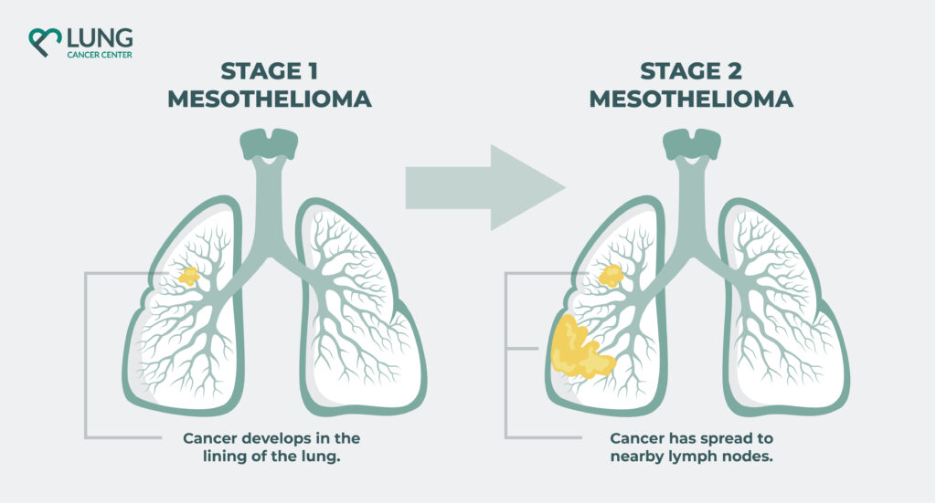 Stage 2 mesothelioma infographic which shows the difference and spread of mesothelimoa from stage 1 to stage 2.
