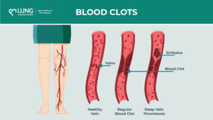 Infographic showing a healthy vein, a regular blood clot, and deep vein thrombosis with a leg with veins