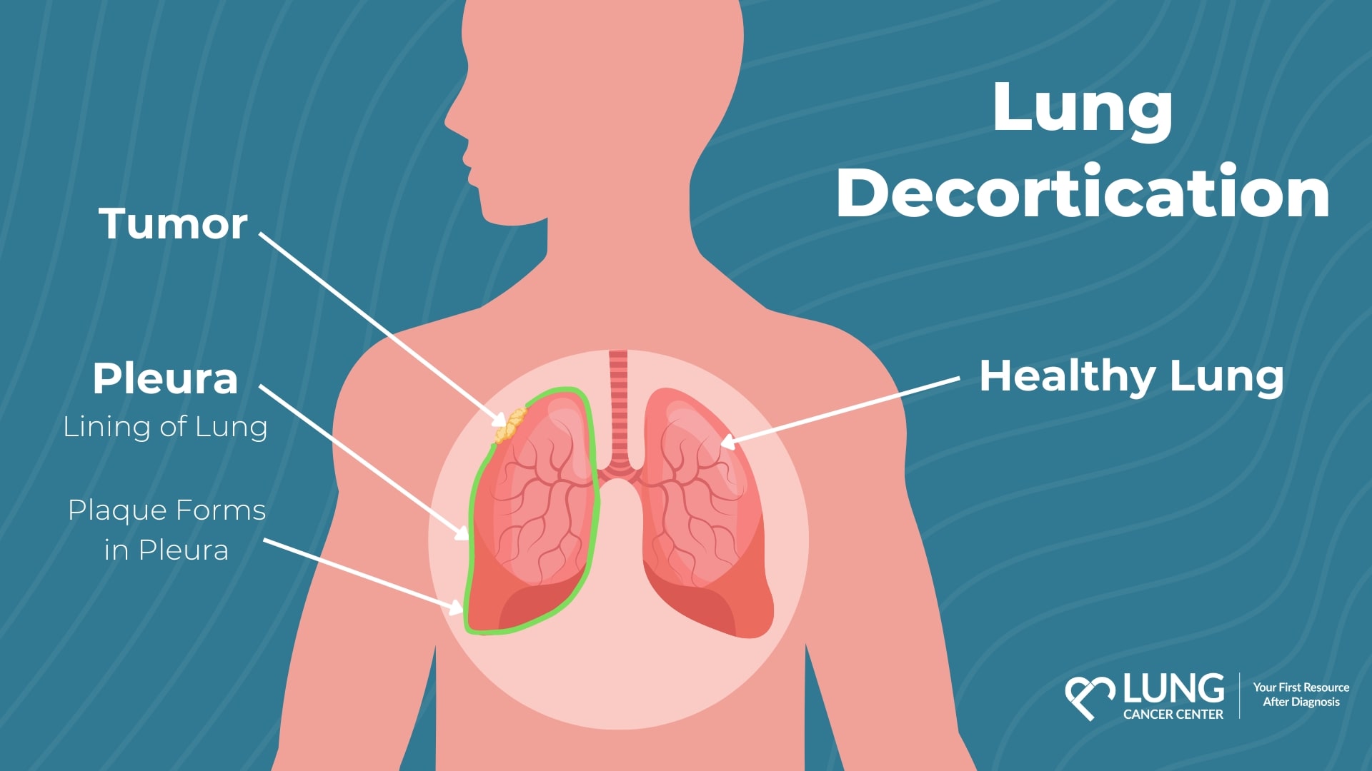 Infographic showing the body parts lung decortication affect, including the pleura, tumor, and a healthy lung