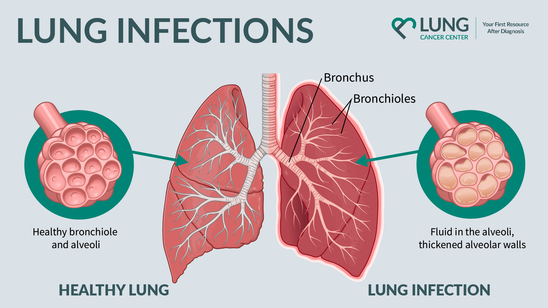 Pulmonery Lung Infections And The Respiratory System